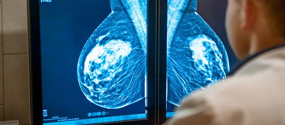 ทำไมผู้หญิงต้องตรวจแมมโมแกรม (mammogram)?